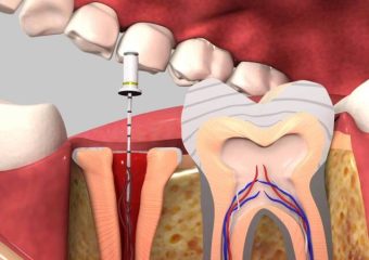 علل نیاز به انجام روت کانال مجدد دندان | بهترین ایمپلنت اصفهان