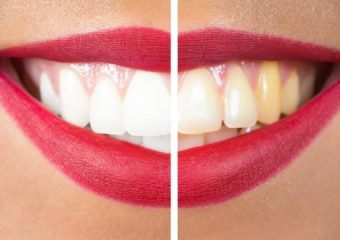 عوامل تغییر رنگ لمینت دندان و پیشگیری از آن | بهترین دندانپزشک اصفهان