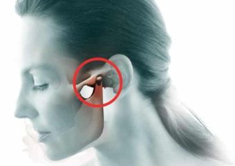 عوامل مشکلات مفصل فکی گیجگاهی | بهترین دندانپزشک زیبایی اصفهان