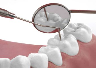 نگهداری و استفاده از فیلینگ کامپوزیت دندان | بهترین دندانپزشک اصفهان