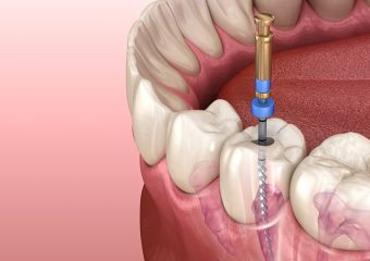 پاسخ به سوالات رایج در مورد روت کانال دندان | بهترین ایمپلنت اصفهان