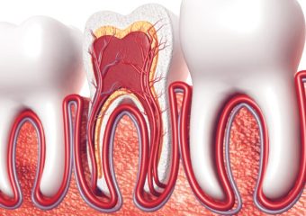 بررسی مزایای درمان ریشه دندان | بهترین ایمپلنت اصفهان