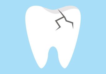 بررسی نشانه سندروم ترک دندان | بهترین دندانپزشک اصفهان
