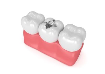 استفاده از آمالگام چه مزیتها و معایبی دارد؟ | بهترین دندانپزشک زیبایی اصفهان