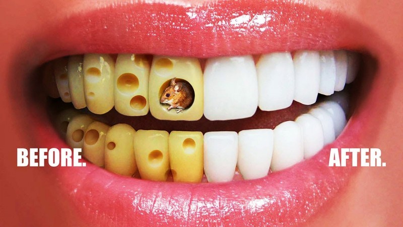 بررسی علل و عوارض پوسیدگی دندان | بهترین دندانپزشک اصفهان