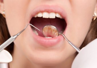 بررسی علل و عوارض پوسیدگی دندان | بهترین دندانپزشک اصفهان