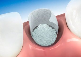 تاثیر پودر استخوان Bottis در موفقیت کاشت ایمپلنت دندان | بهترین دندانپزشک زیبایی اصفهان