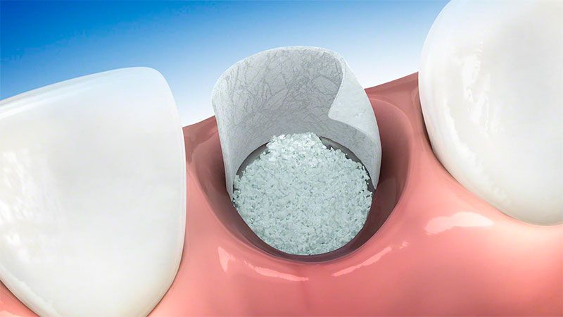 تاثیر پودر استخوان Bottis در موفقیت کاشت ایمپلنت دندان | بهترین دندانپزشک زیبایی اصفهان