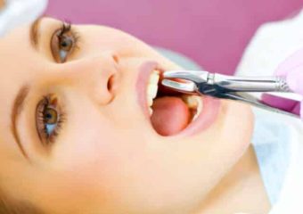 دلایل کشیده شدن دندان‌ها چیست؟ | بهترین دندانپزشک اصفهان