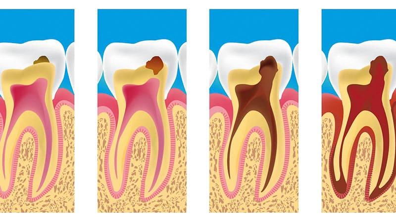 روش های جلوگیری پوسیدگی دندان | بهترین دندانپزشک زیبایی اصفهان
