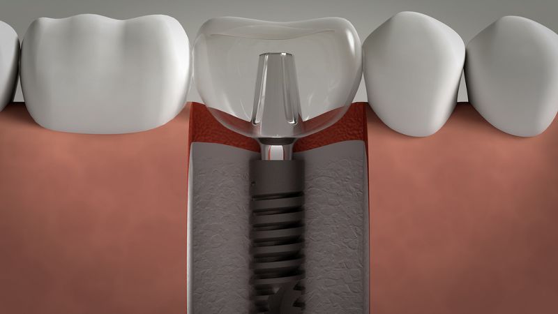 ریسک های عمل جراحی کاشت ایمپلنت چیست؟ | بهترین دندانپزشک اصفهان