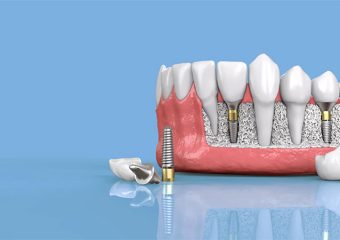 ریسک های عمل جراحی کاشت ایمپلنت چیست؟ | بهترین دندانپزشک اصفهان