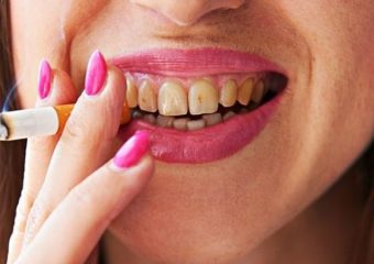 عوامل خطرزا در پوسیدگی دندان | بهترین ایمپلنت اصفهان