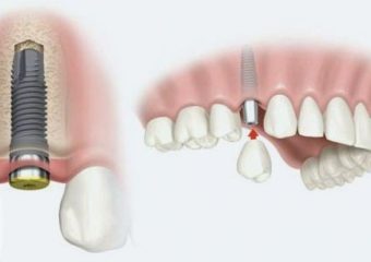 موارد قابل درمان با ایمپلنت‌های دندانی زیر پریوستال | بهترین دندانپزشک اصفهان