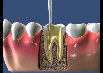 نجات دندان با درمان ریشه | بهترین ایمپلنت اصفهان