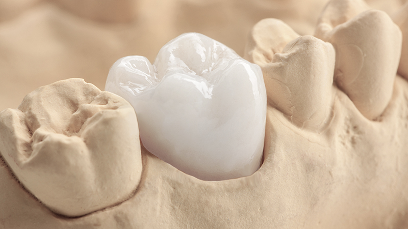 کاربردهای تاج دندان مصنوعی چیست؟ | بهترین دندانپزشک اصفهان