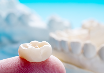 کاربردهای تاج دندان مصنوعی چیست؟ | بهترین دندانپزشک اصفهان