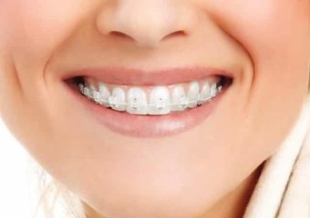 مزیت های انجام ارتودنسی نامرئی و شفاف | بهترین ایمپلنت اصفهان