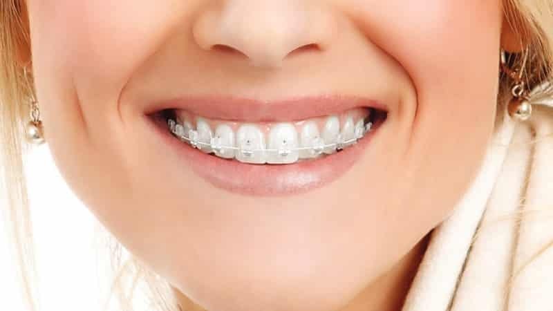 مزیت های انجام ارتودنسی نامرئی و شفاف | بهترین ایمپلنت اصفهان