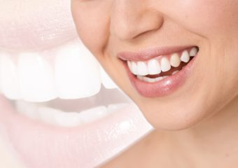 آشنایی با انواع مختلف لمینت | بهترین ایمپلنت اصفهان