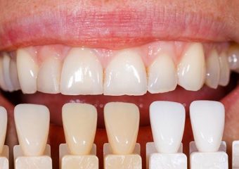 اجتناب از این غذاها هنگام استفاده از ونیرهای موقت | بهترین ایمپلنت اصفهان