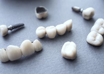 بررسی ارتباط بین ایمپلنت دندان و بروز سرطان | بهترین ایمپلنت اصفهان