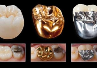 بررسی انواع تاج دندان | بهترین دندانپزشک زیبایی اصفهان