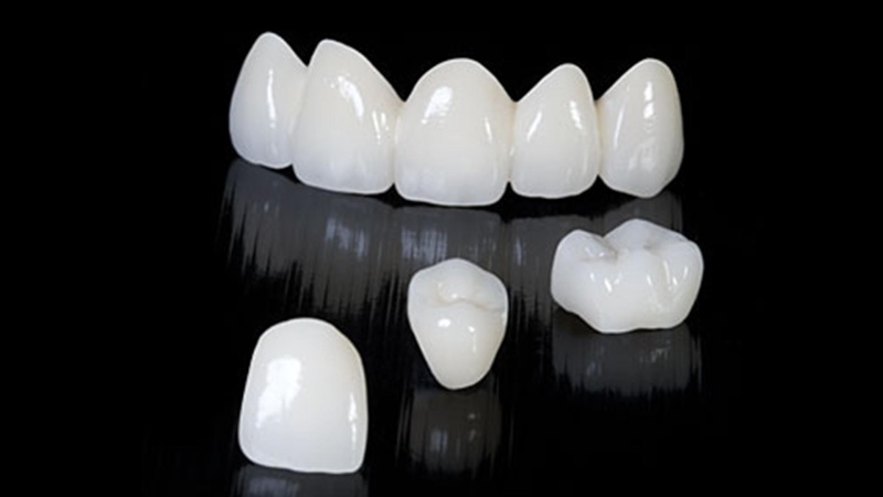 بررسی انواع تاج دندان | بهترین دندانپزشک زیبایی اصفهان