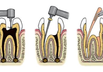 بررسی زمان نیاز به روت کانال مجدد دندان | بهترین ایمپلنت اصفهان