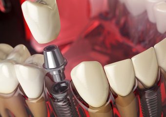 بررسی درمان های لق شدن ایمپلنت دندان | بهترین ایمپلنت اصفهان