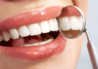 دلایل استفاده از لاک سفید کننده دندان | بهترین ایمپلنت اصفهان