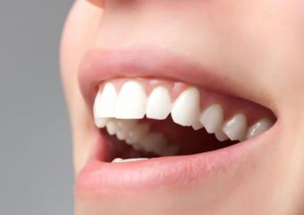 راه های مراقبت از تاج دندان | بهترین دندانپزشک اصفهان