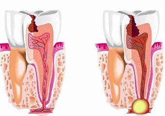 علل ایجاد آبسه دندان | بهترین دندانپزشک اصفهان