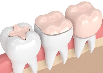 عوارض پس از نصب تاج دندان چیست؟ | بهترین ایمپلنت اصفهان