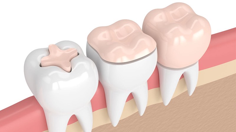عوارض پس از نصب تاج دندان چیست؟ | بهترین ایمپلنت اصفهان