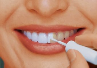 مزایا و عوارض مصرف لاک سفید کننده دندان | بهترین ایمپلنت اصفهان