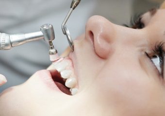 میزان آسیب به دندانها با جرمگیری | بهترین دندانپزشک زیبایی اصفهان