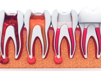 نکات مهم در عصب کشی و درمان ریشه دندان | بهترین دندانپزشک اصفهان