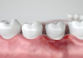 علل بیماری پریودنتال لثه چیست؟ | بهترین دندانپزشک اصفهان