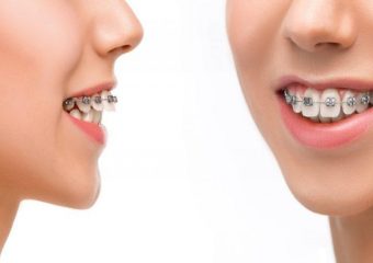 بررسی انواع مال اکلوژن دندان | بهترین دندانپزشک اصفهان