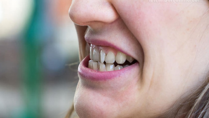 بررسی انواع مال اکلوژن دندان | بهترین دندانپزشک اصفهان