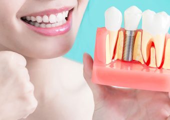 بهترین عوامل تعیین کننده کاشت موفق دندان | بهترین دندانپزشک زیبایی اصفهان