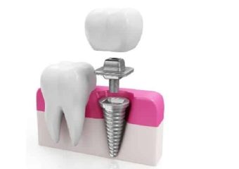 راه کارهای محافظت و افزایش طول عمر ایمپلنت‌های دندانی | بهترین دندانپزشک زیبایی اصفهان