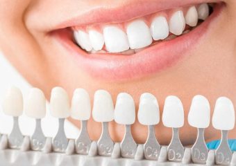 راهنمای انتخاب رنگ لمینت دندان | بهترین ایمپلنت اصفهان