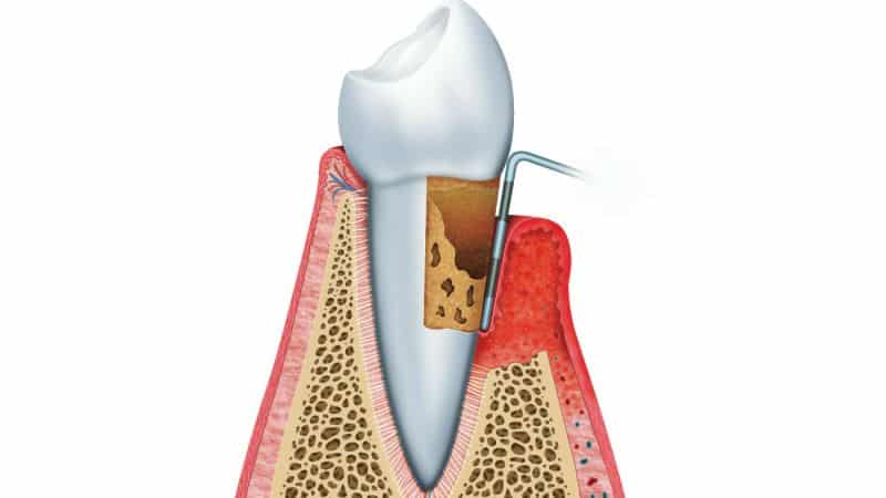 رایج ترین علائم بیماری پریودنتال | بهترین دندانپزشک اصفهان