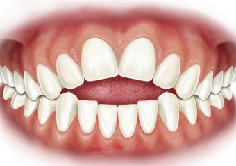 علل و انواع ناهنجاری اپن بایت چیست؟ | بهترین دندانپزشک اصفهان