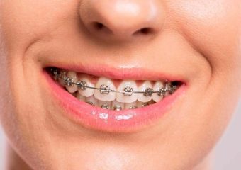 مقایسه مزایا و معایب ارتودنسی و کامپوزیت دندان | بهترین ایمپلنت اصفهان