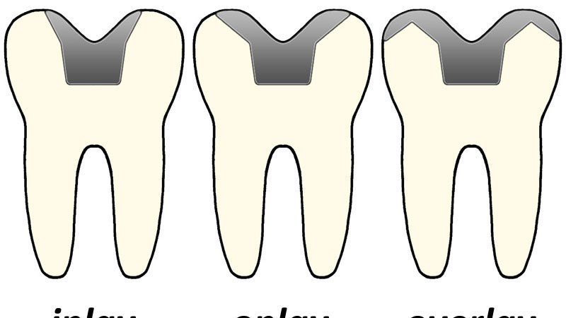 موارد جایگزین برای آمالگام دندان چیست؟ | بهترین دندانپزشک زیبایی اصفهان