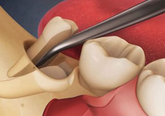 نحوه درمان شکستگی ریشه دندان | بهترین دندانپزشک زیبایی اصفهان