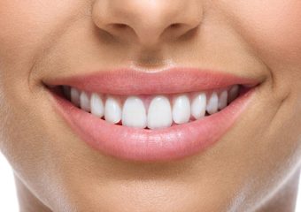 نکات مهم در نگهداری و ترمیم کامپوزیت دندان | بهترین ایمپلنت اصفهان